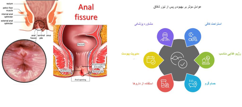 بعد از عمل شقاق چی بخوریم؟